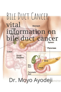 Bile duct cancer
