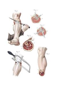Amputation of the Leg Notebook