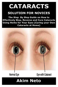 Cataracts Solution for Novices