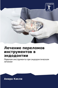 Лечение переломов инструментов в эндодон
