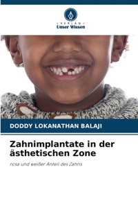 Zahnimplantate in der ästhetischen Zone