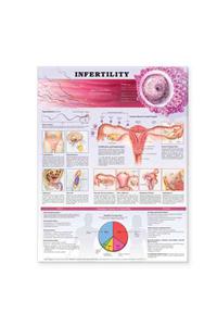 Infertility Anatomical Chart