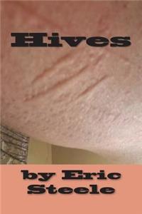 Hives