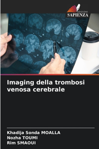 Imaging della trombosi venosa cerebrale