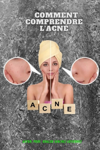 Comment comprendre l'acné