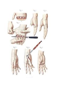 Disarticulation of the Four Fingers and of the Thumb Composition Notebook