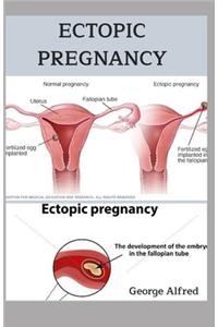 Ectopic Pregnancy