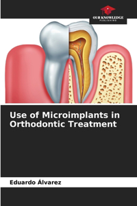 Use of Microimplants in Orthodontic Treatment