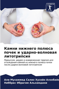 Камни нижнего полюса почек и ударно-волноk