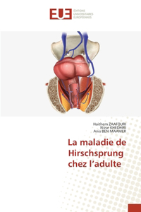 maladie de Hirschsprung chez l'adulte