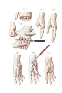 Disarticulation of the Four Fingers and of the Thumb