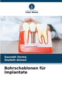 Bohrschablonen für Implantate