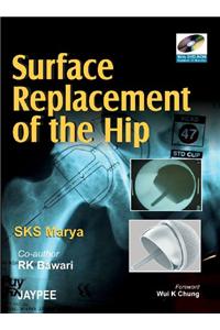 Surface Replacement of the Hip