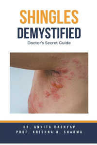 Shingles Demystified: Doctor's Secret Guide