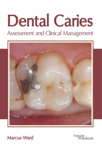 Dental Caries: Assessment and Clinical Management
