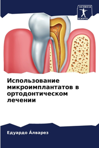 Использование микроимплантатов в ортодо&