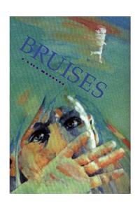 Bruises