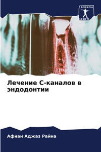 Лечение С-каналов в эндодонтии