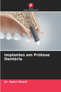 Implantes em Prótese Dentária