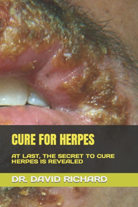 Cure for Herpes