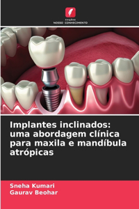 Implantes inclinados