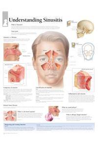 Understanding Sinusitis Chart