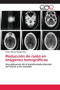 Reducción de ruido en imágenes tomográficas