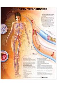 Deep Vein Thrombosis Anatomical Chart