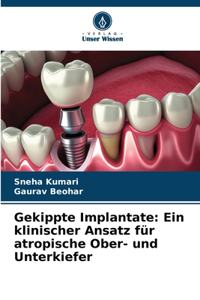 Gekippte Implantate