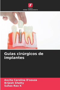 Guias cirúrgicos de implantes