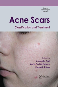 Acne Scars