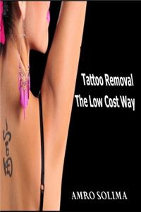 Tattoo Removal