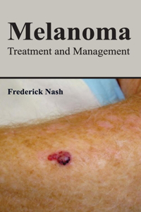 Melanoma: Treatment and Management