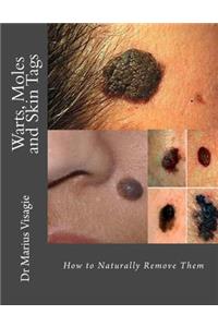 Warts, Moles and Skin Tags: How to Naturally Remove Them