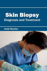 Skin Biopsy: Diagnosis and Treatment