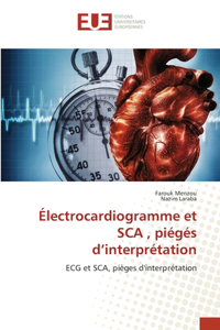 Électrocardiogramme et SCA, piégés d'interprétation