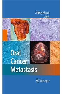 Oral Cancer Metastasis