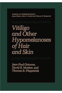 Vitiligo and Other Hypomelanoses of Hair and Skin