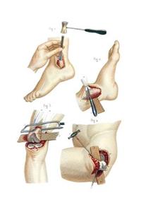 Resections Performed on the Lower Extremity Notebook