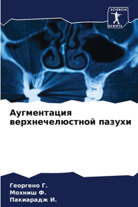 Аугментация верхнечелюстной пазухи