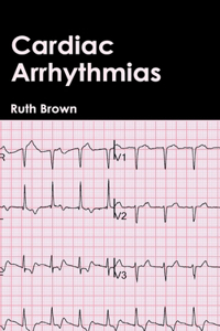 Cardiac Arrhythmias