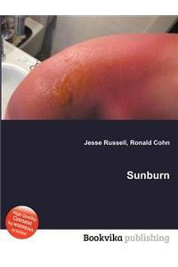 Sunburn