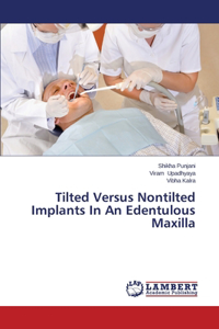 Tilted Versus Nontilted Implants In An Edentulous Maxilla