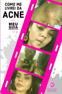 COMO ME LIVREI DA ACNE - Meu guia definitivo