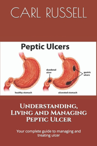 Understanding, Living and Managing Peptic Ulcer