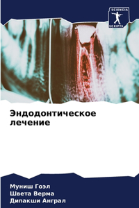 Эндодонтическое лечение