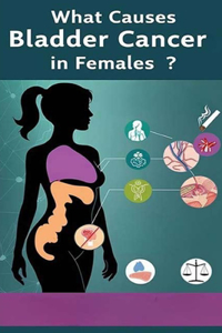 What Causes Bladder Cancer in Females?