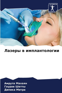 Лазеры в имплантологии