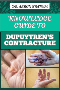 Knowledge Guide to Dupuytren's Contracture