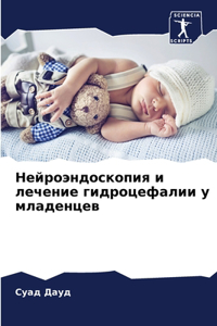 Нейроэндоскопия и лечение гидроцефалии у